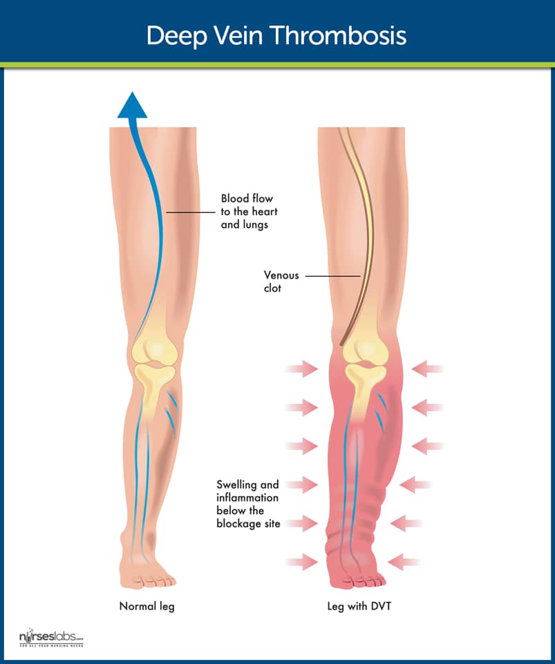 สรุป pathophysio 🎾 Edema 🎾 จาก... - Nakorn - Core Physiology