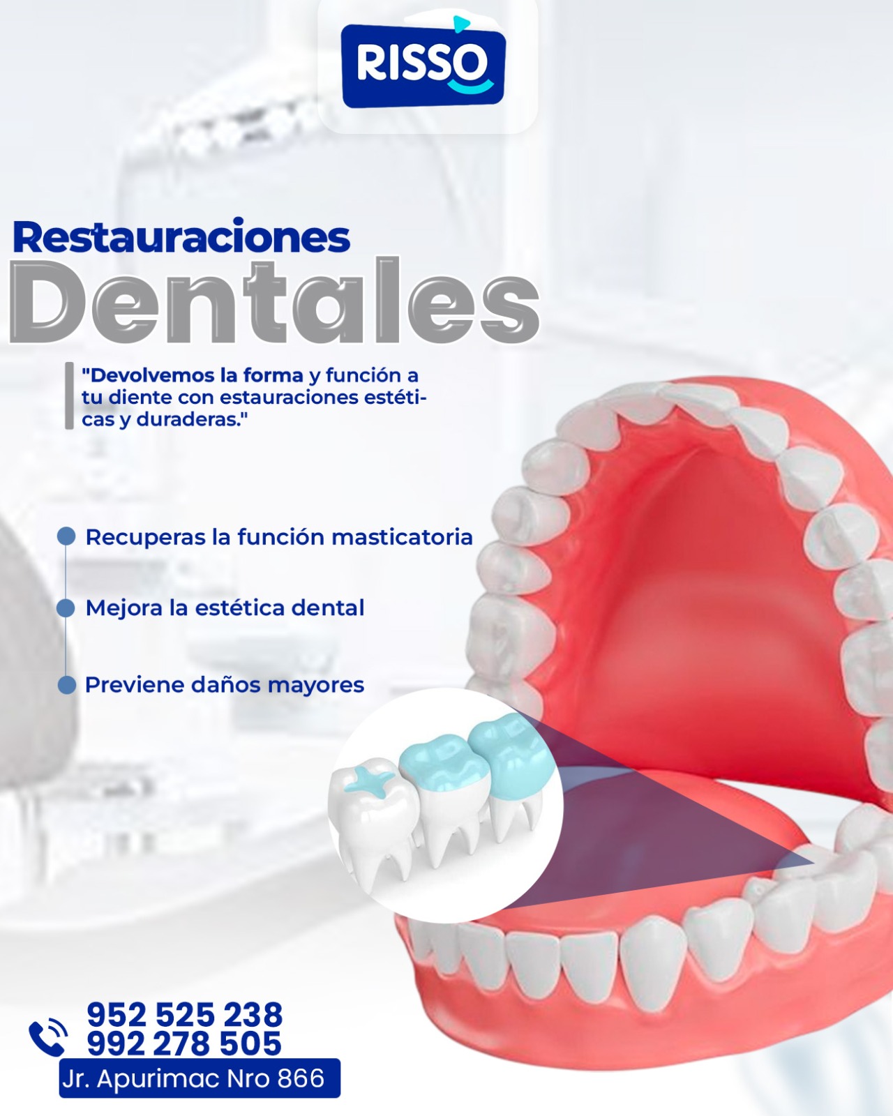 RISSO - 🦷 ¿Dientes con caries, fracturas o desgaste? ¡Recupéralos con ...