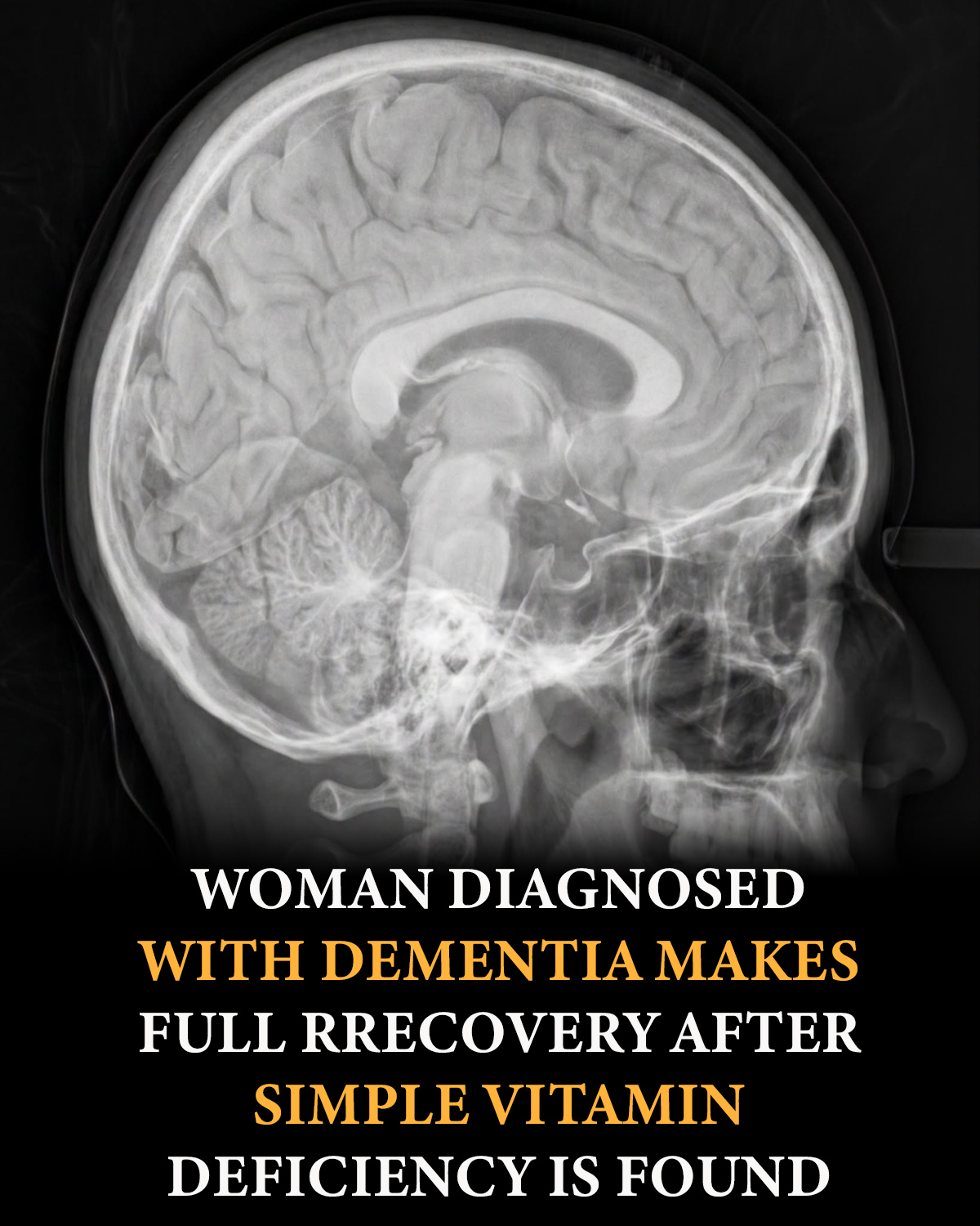 Vitamin B12 deficiency reverses dementia-like decline in woman