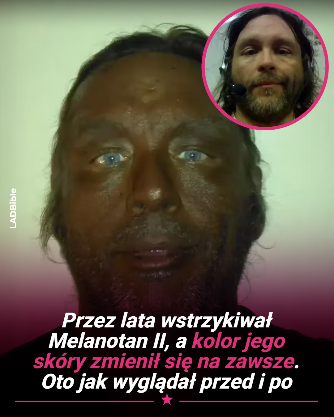 melanotan 2 efekty Jego oczy wciąż są niebieskie. To pierwsza rzecz, którą zauważasz. Wszystko inne się zmieniło. Ten mężczyzna, identyfikowany na forach jako przewlekły użytkownik Melanotanu II, przez lata dokumentował skumulowany efekt wstrzykiwania sobie syntetycznego USA Shoe Size:9.5