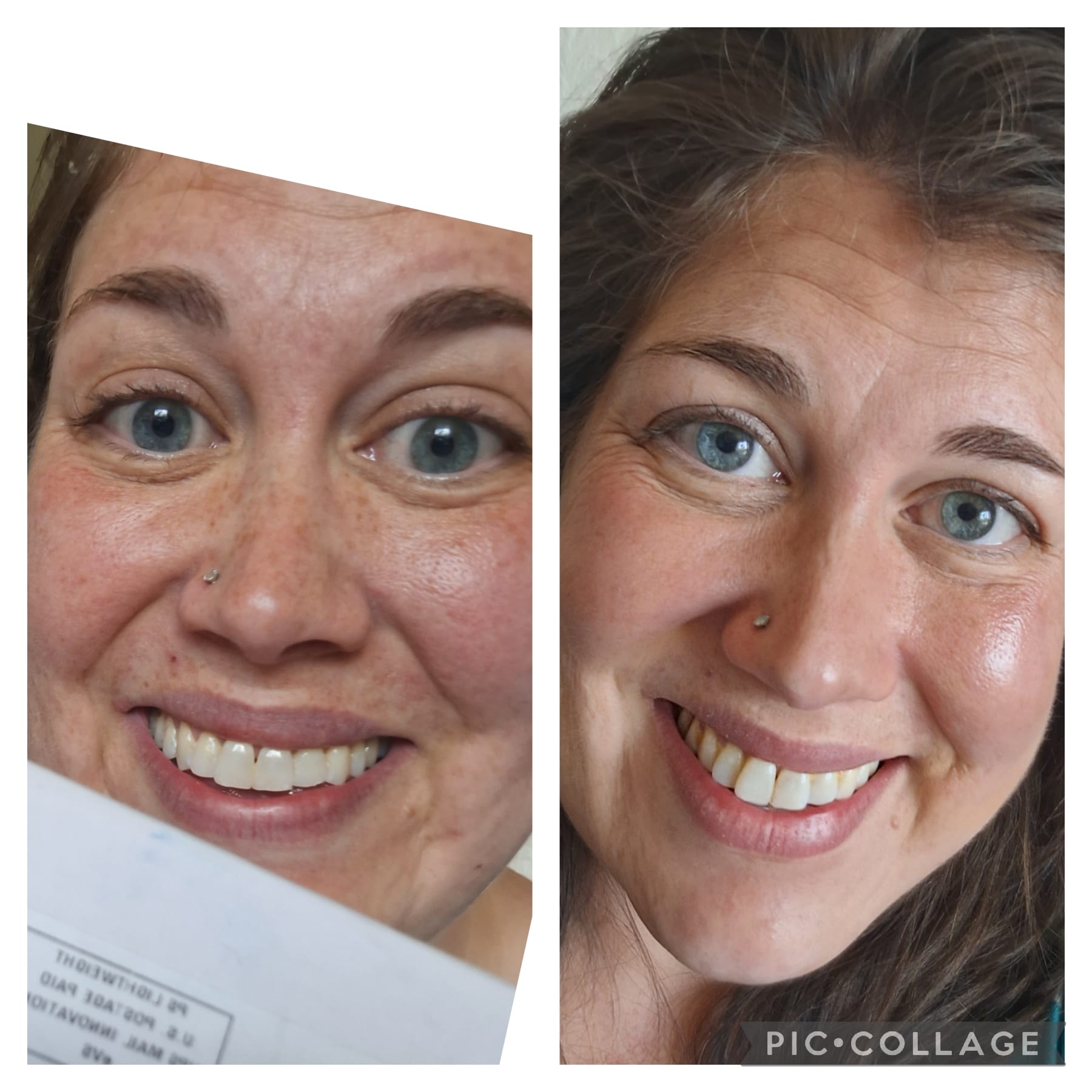 glutathione injection skin whitening evidence Injections for Whitening: Before & After 8010840001: Glutathione sirf girls ke