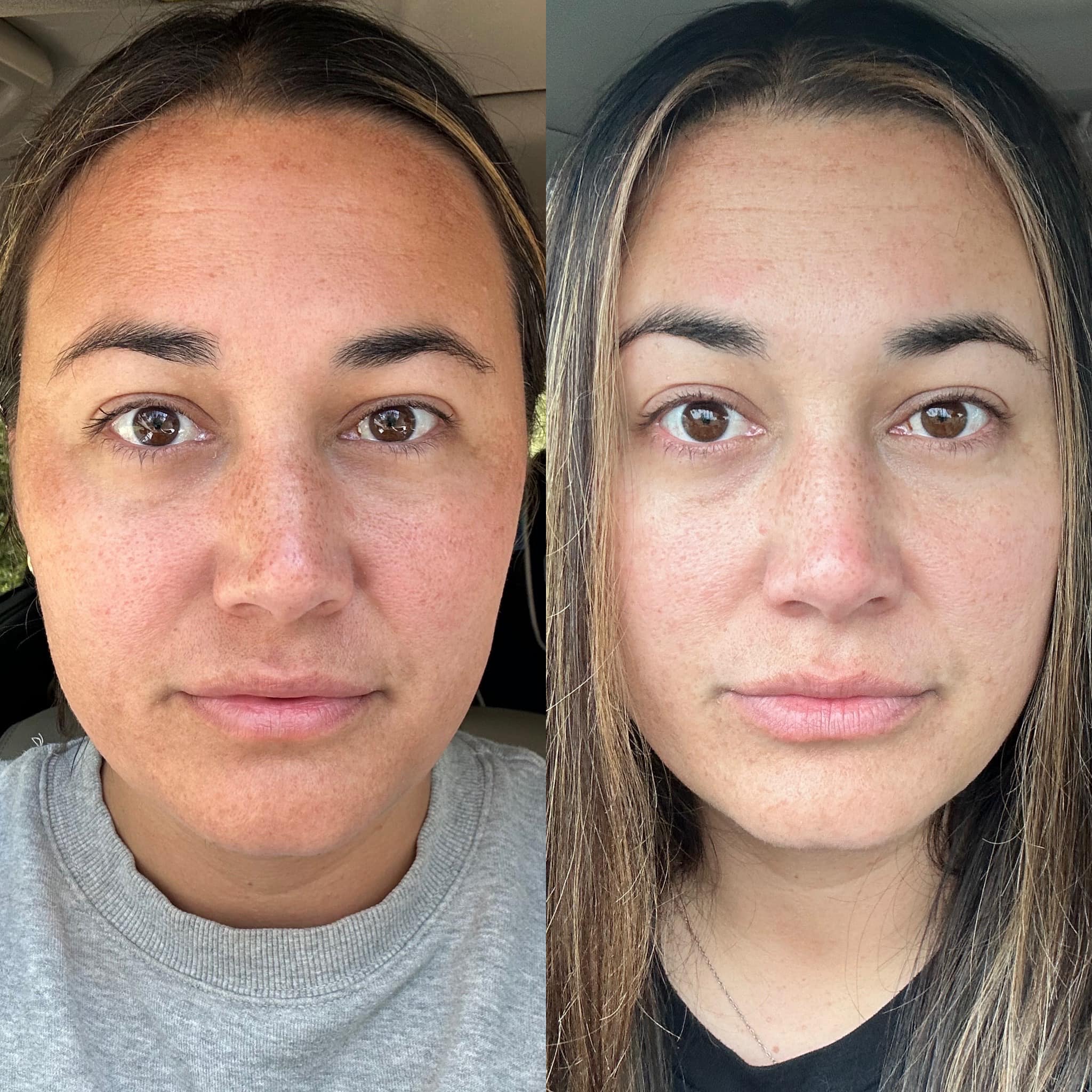 glutathione lighten eye colour can eyes Glutathione IV Therapy in Seattle for Radiant, Even Skin glutathione eye drops change eye  This changes the complexion completely