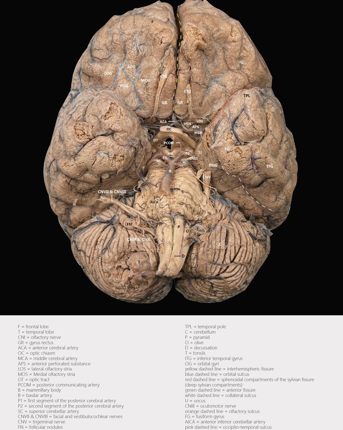 TBI - The inferior surface of the 🧠, also known as the basal surface ...