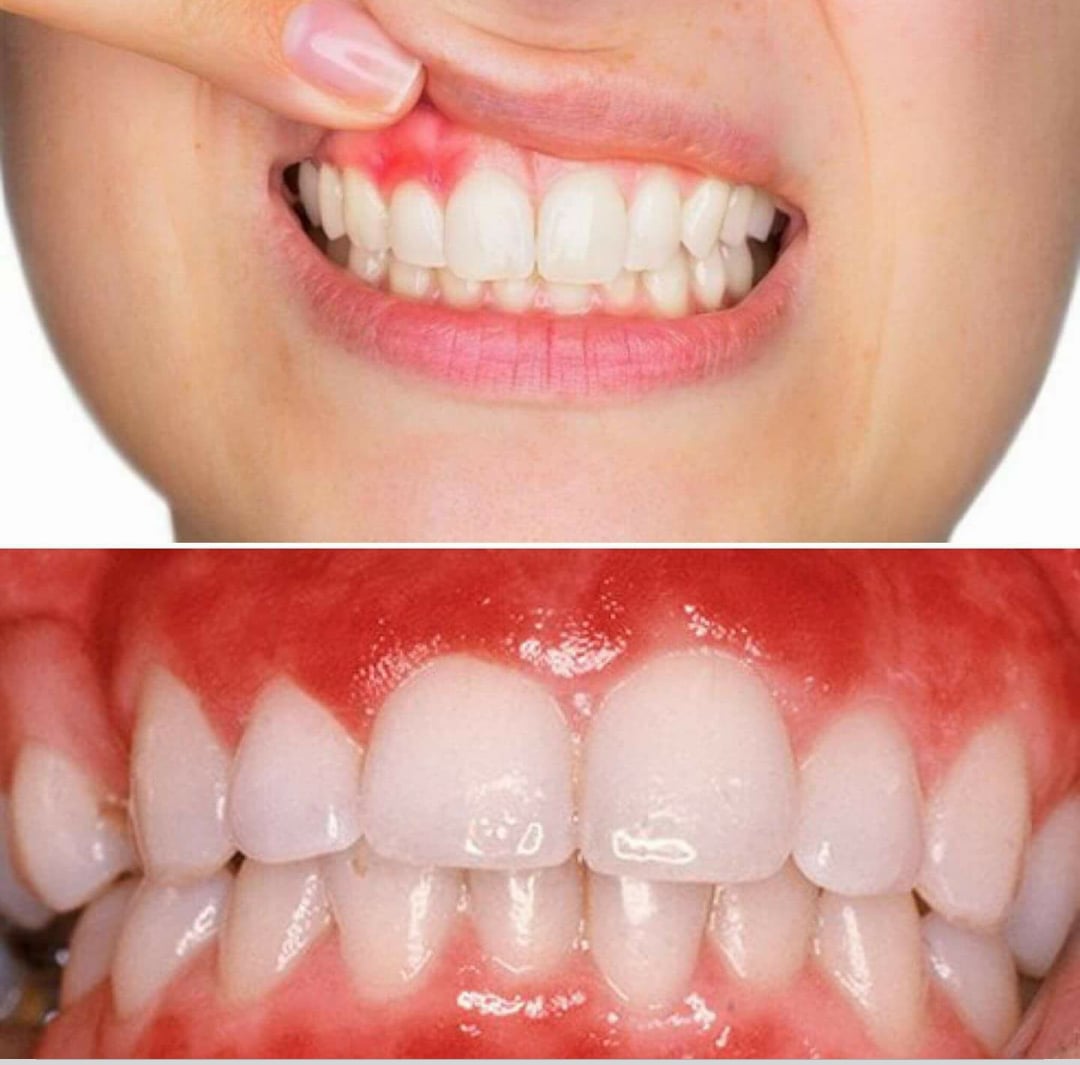 الملتقى التعليمي لطب الاسنان التهاب اللثة أنواع أسباب أعراض أفضل طرق للعلاج 1 ما هو التهاب اللثة 2 ما هى أسباب التهاب اللثة 3 ما هي أنواع