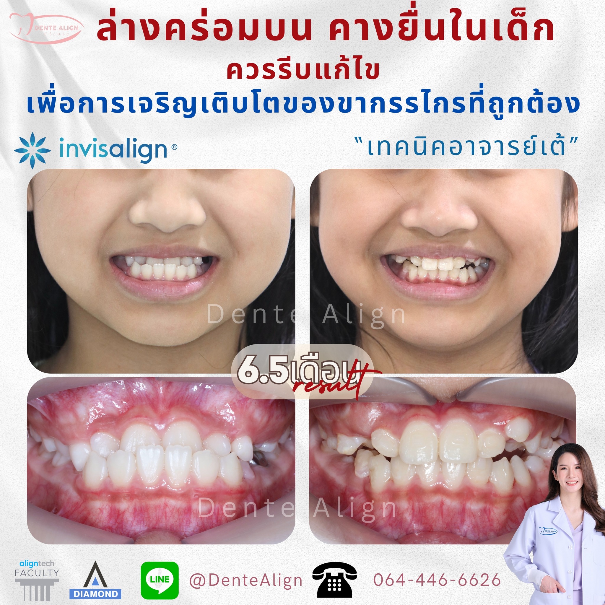 🎉ปัญหาล่... - Dente Align Clinic - Invisalign Diamond Provider