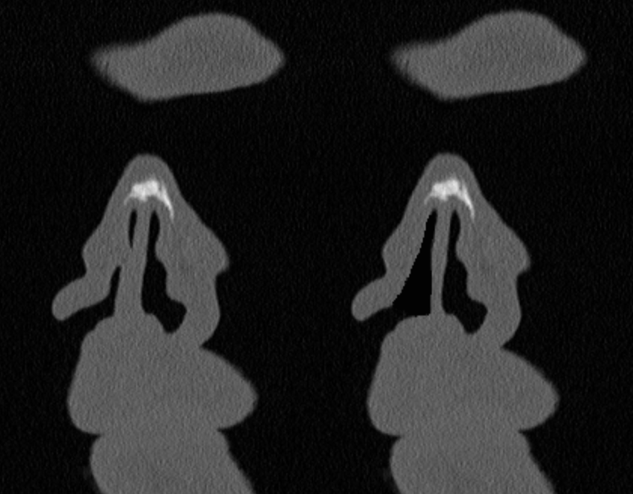 Nasal Obstruction CFD Analysis - Sinuflow