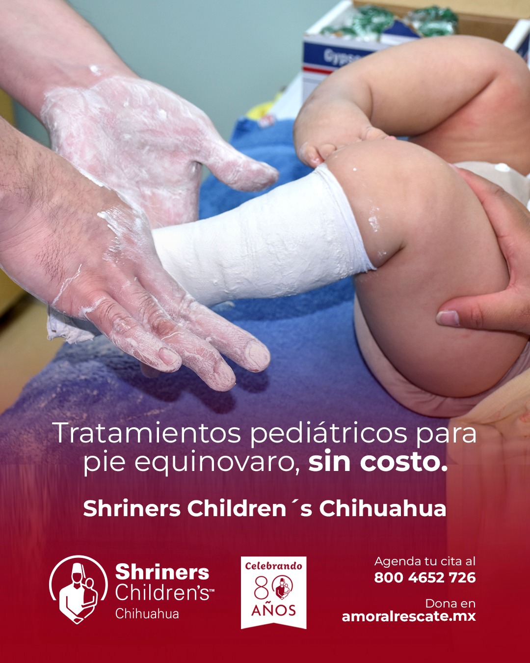Hospital - El método Ponseti es una opción efectiva para tratar el pie ...