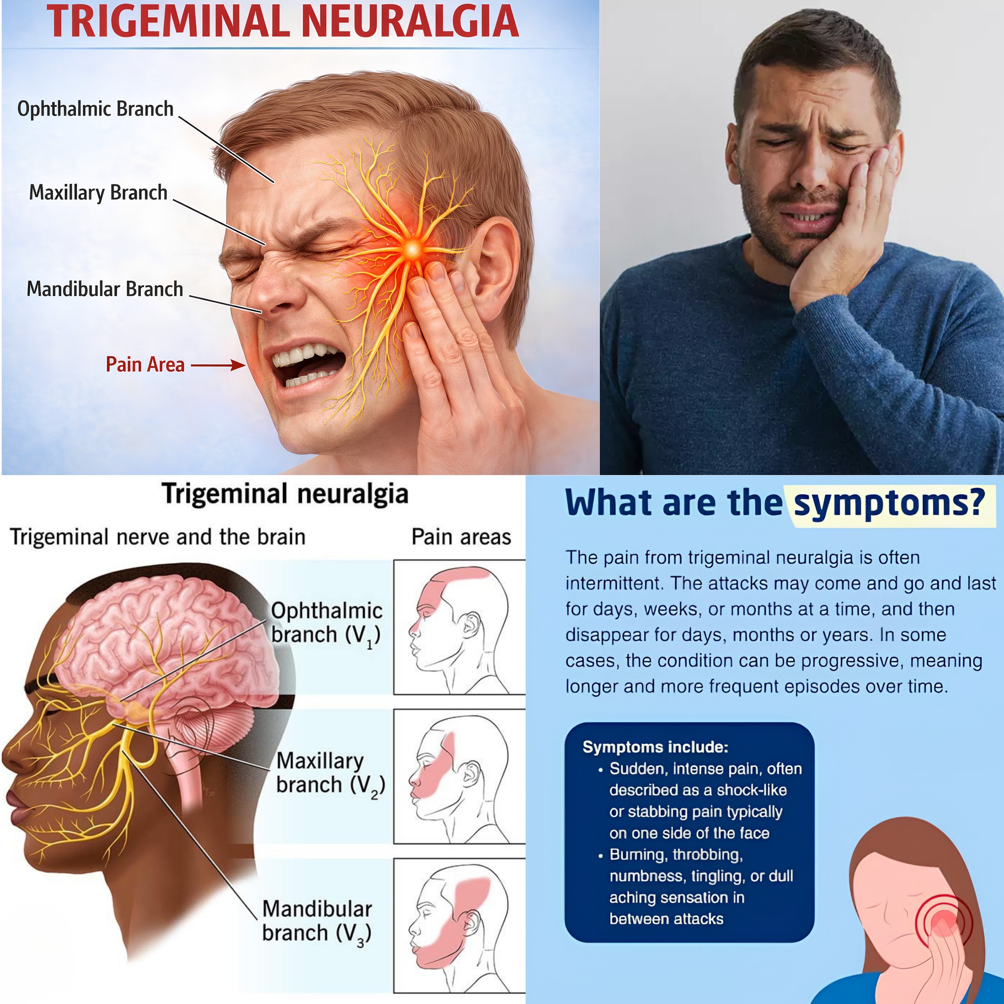 Natural ways to manage Trigeminal Neuralgia pain?