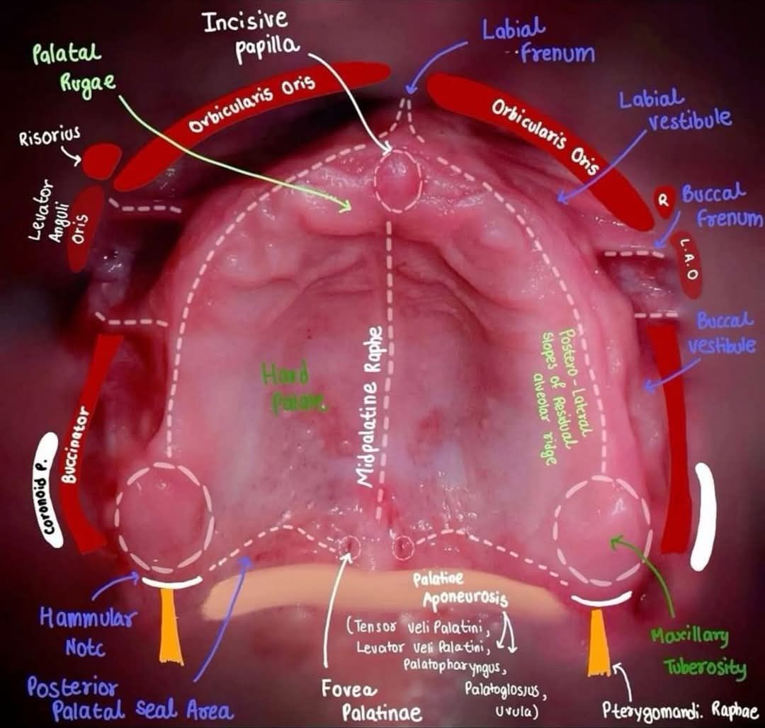 All - 🚫 Anatomy of the edentulous upper arch | Facebook