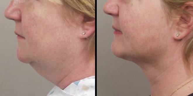 JPC Aesthetics - *** Nerfertiti Neck and Jaw Lift *** The... | Facebook