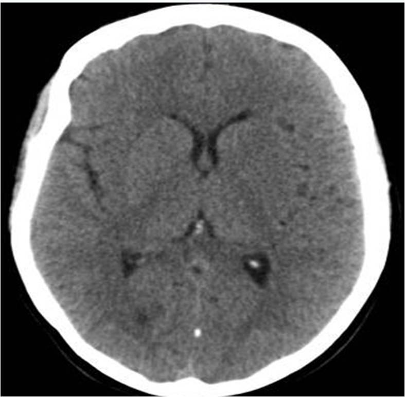 醫療影像教學 - Early ischemic stroke 在很早期的ischemic stroke時.往往做CT第一時間看不出任何異常 ...