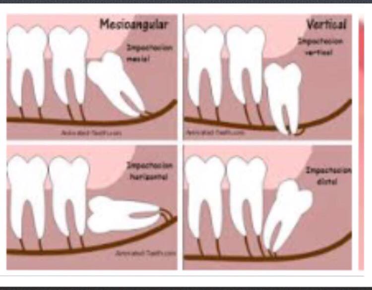 Odontologos - Terceros molares Incluidos PP󾁀󾁀 Excelente presentación ‼️ ...