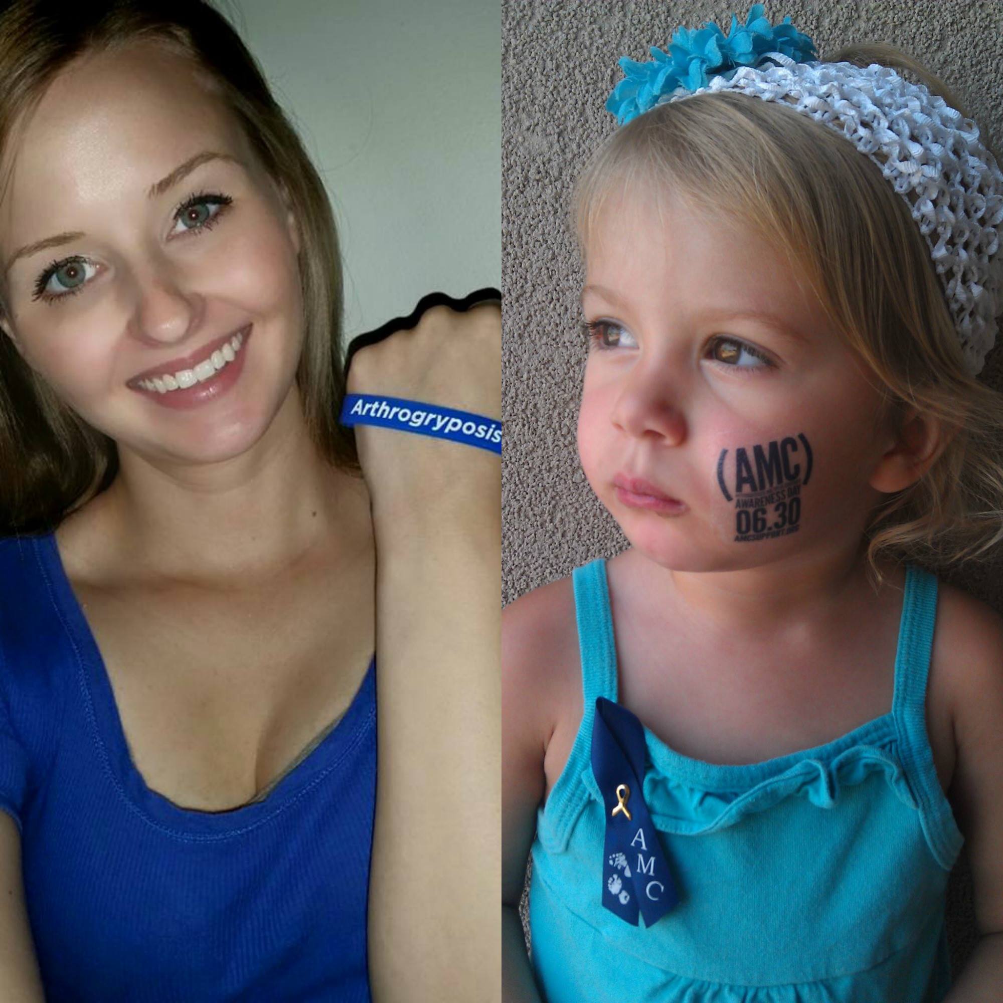 Arthrogryposis Multiplex Congenita Support Inc Arthrogryposis Amc Awareness Day 2016 Is June 30th Don T Forget To Send Us Your Photos With Your Blueforamc Gear Awareness Wristbands Are 5 00 Awareness Ribbons
