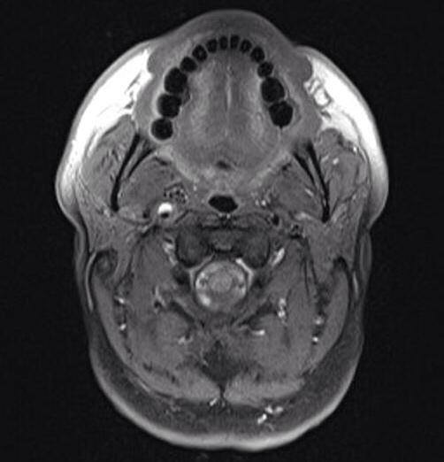 Carotid artery dissection Presentation: A young patient presents with a ...