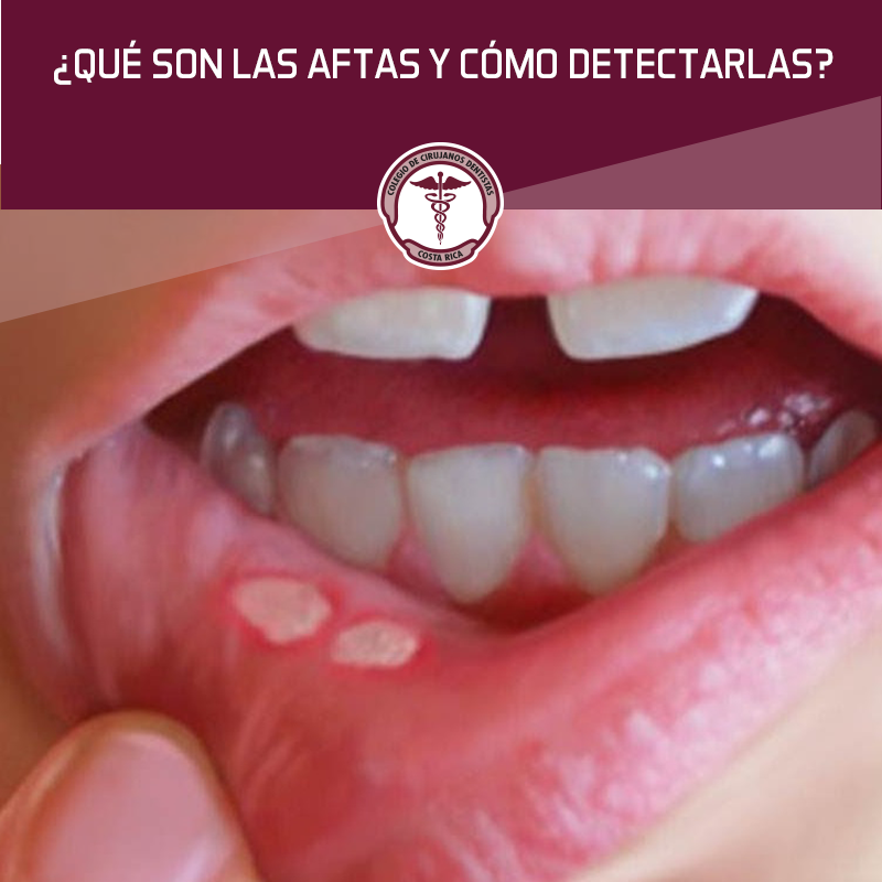 COLEGIO - Las aftas son pequeñas llagas redondas que aparecen en la ...