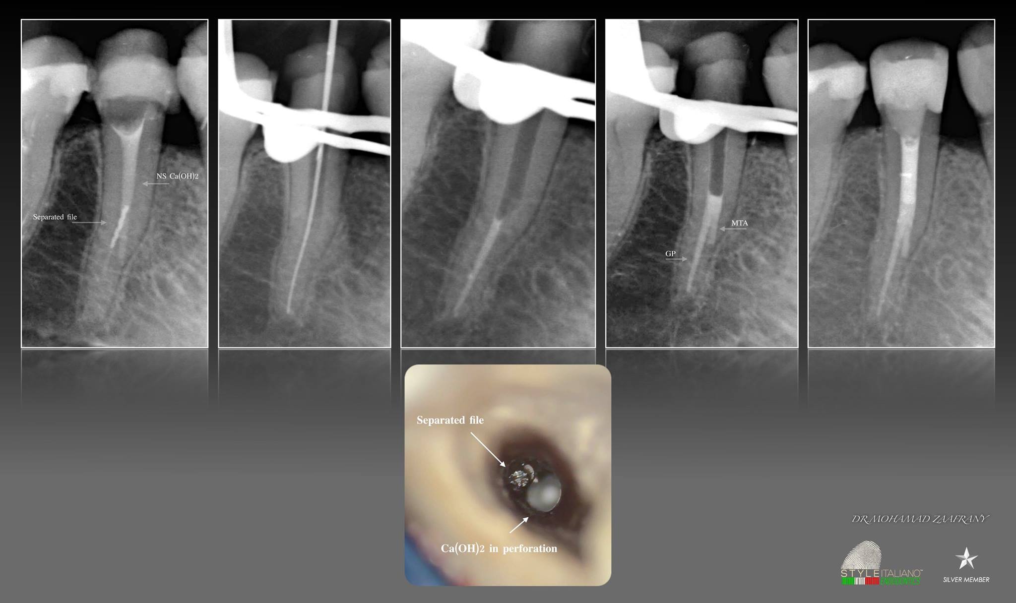 4 broken instrument removal from lower molar