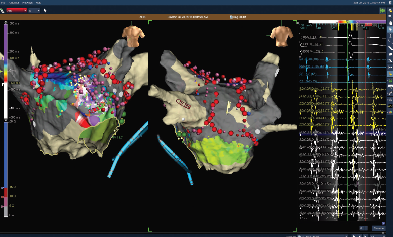 EP Lab Digest - Multi-Electrode Mapping Utilizing a... | Facebook