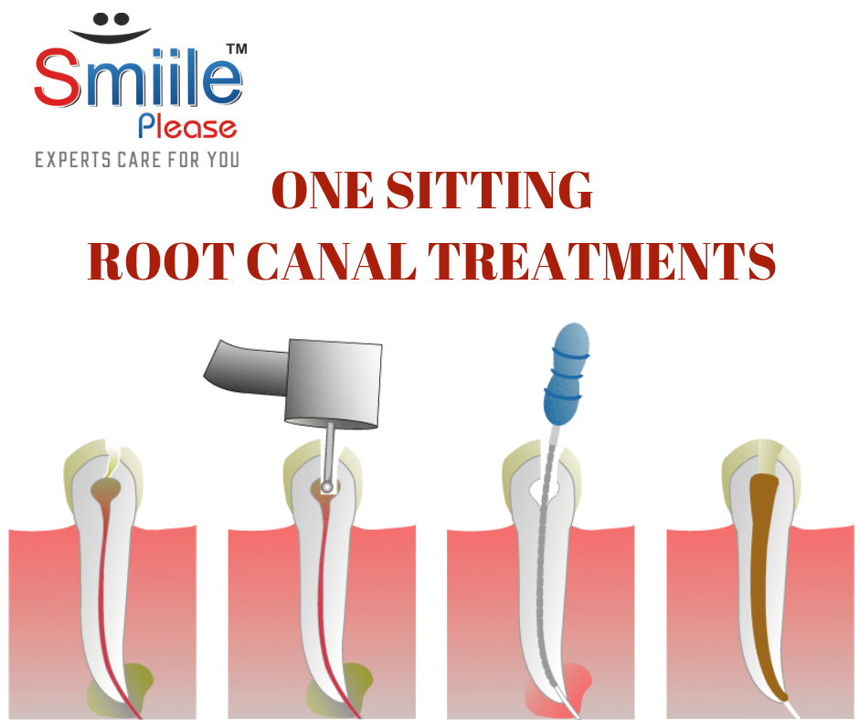 A Single-sitting Root Canal... - Smile Please Dental Clinic
