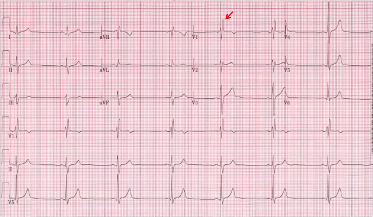 Naser - Incomplete right bundle branch block IRBBB is defined by a QRS ...