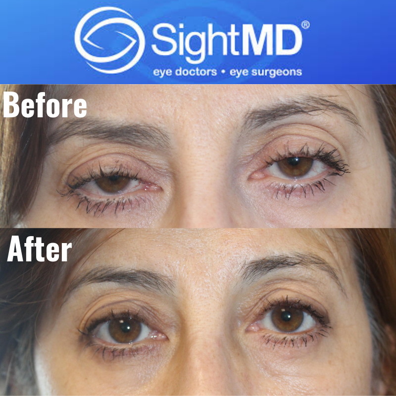 SightMD - #TransformationTuesday Ptosis surgery is a...