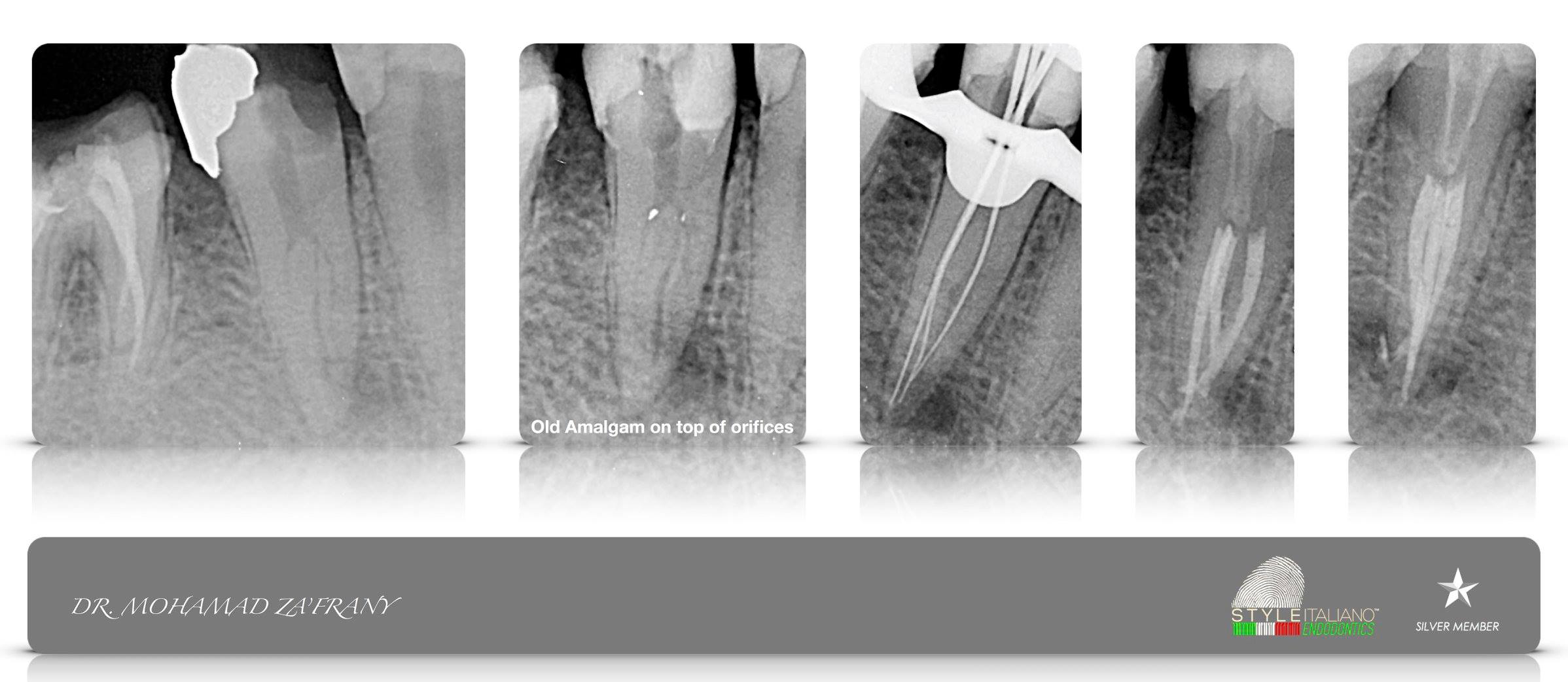 Endodontic treatment for necrotic tooth with chronic apical 