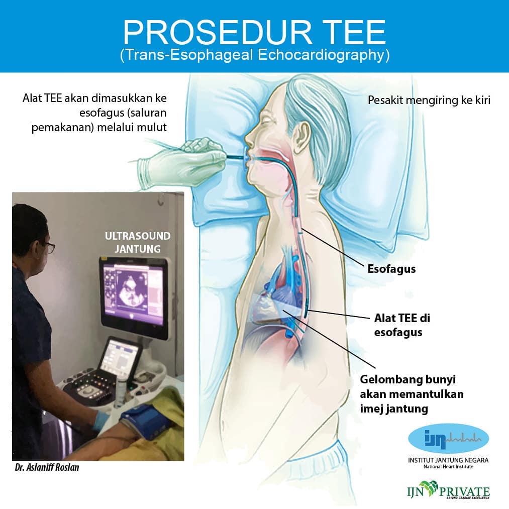 Institut - Do you know what is TEE? Trans Esophageal Echocardiography ...