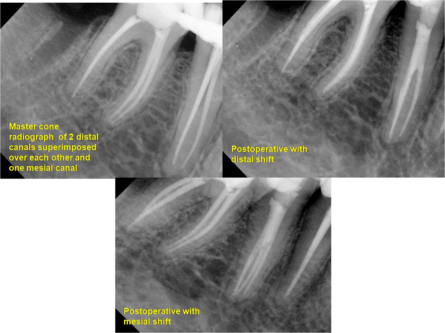 Severe calcification treatment with ultrasonic tip and protaper