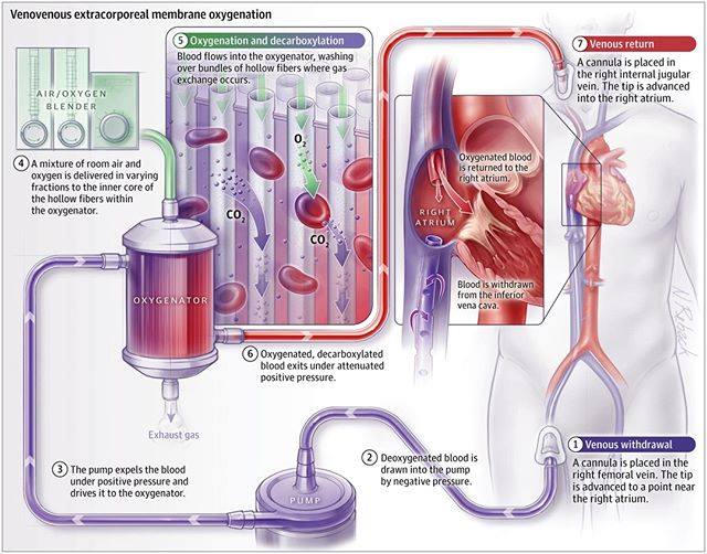 JAMA - Extracorporeal life support provides support to failing lungs, a ...