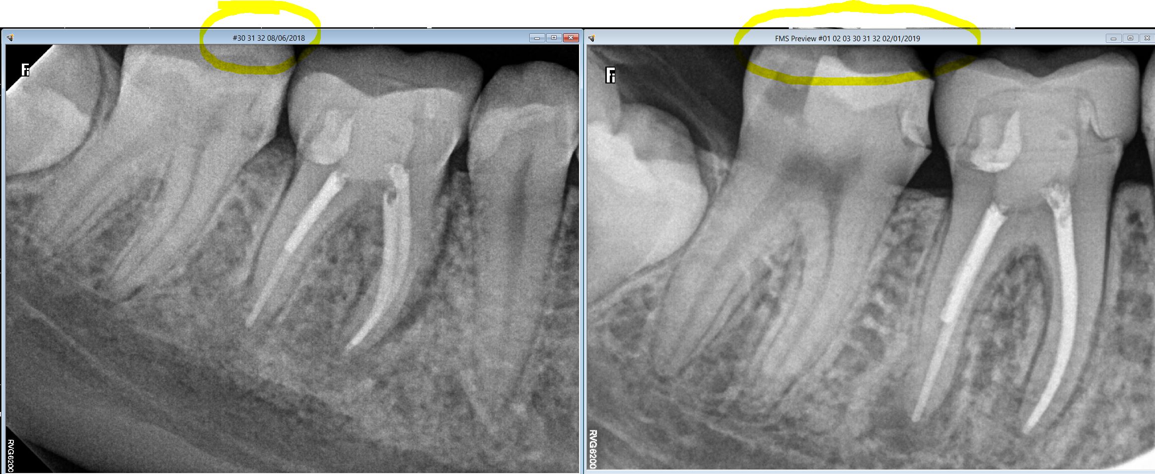 Guy - Dentist who did this RCT on first molar stated that there were ...