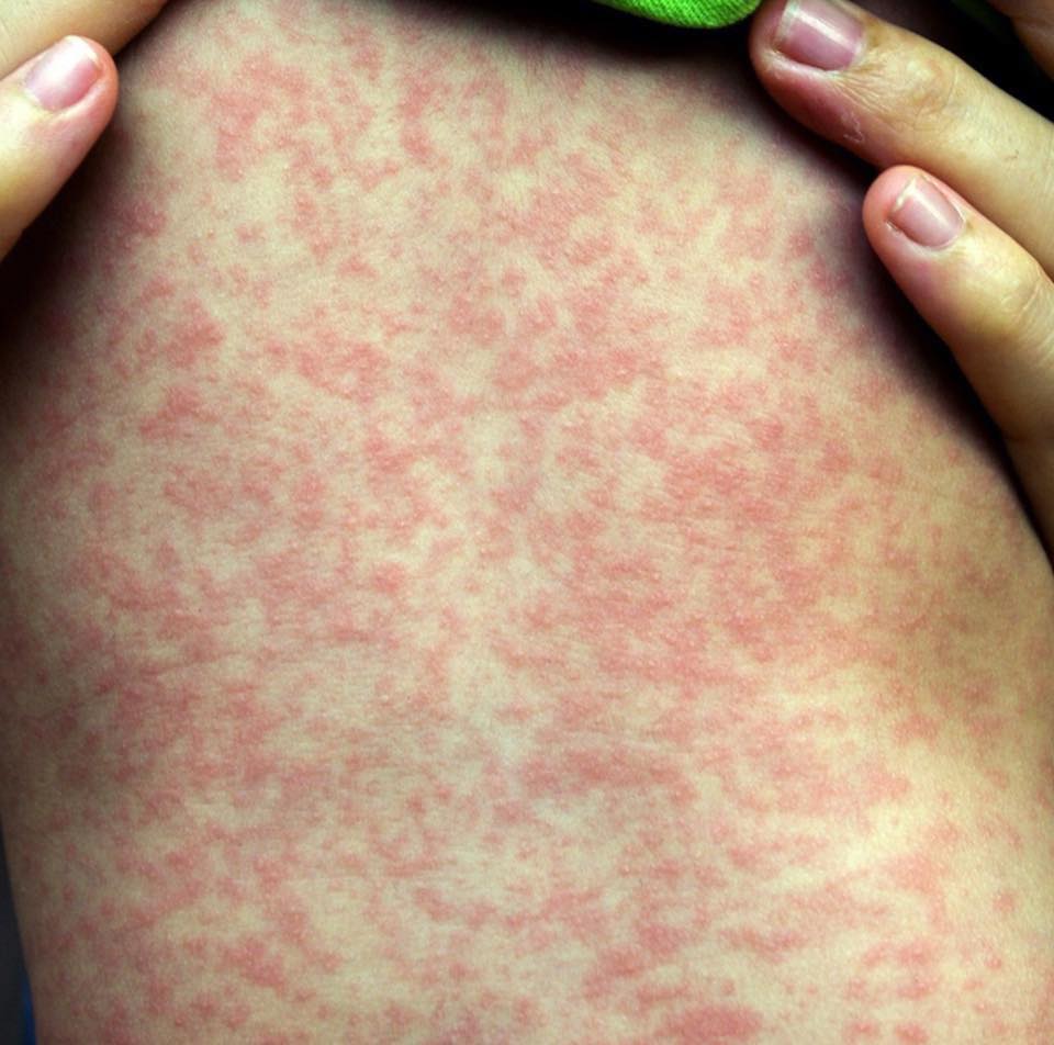 ABC Brisbane - ⚠️MEASLES ALERT - BRISBANE’S SOUTHSIDE ⚠️ Metro South ...