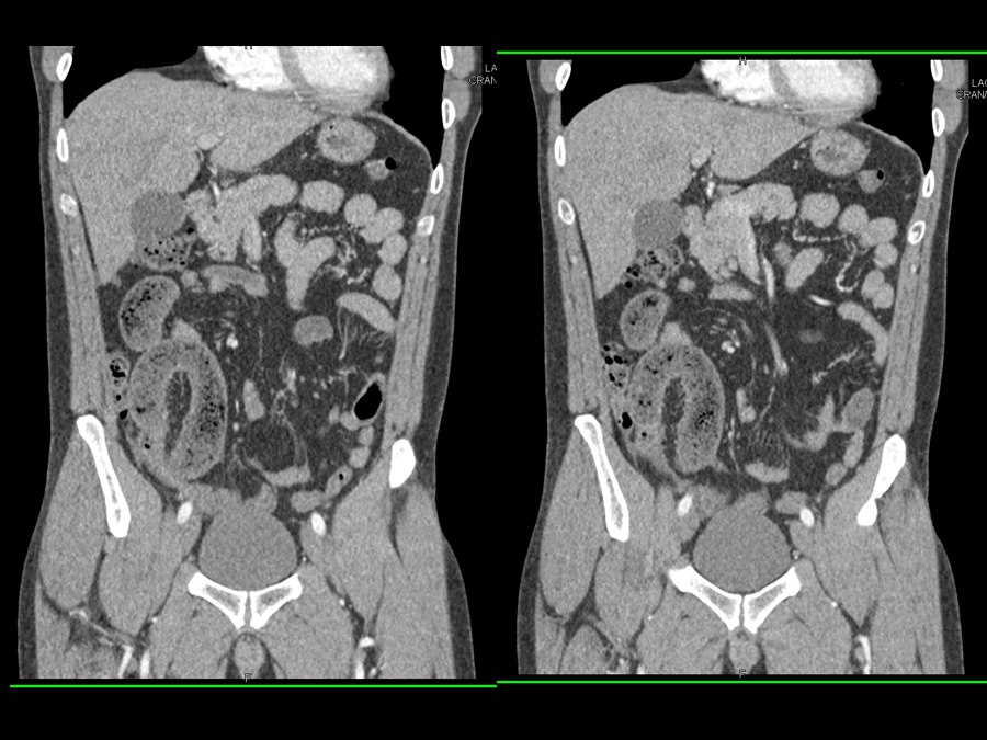 SBO with SB... - CTisus: Cutting edge information on body CT (Computed ...