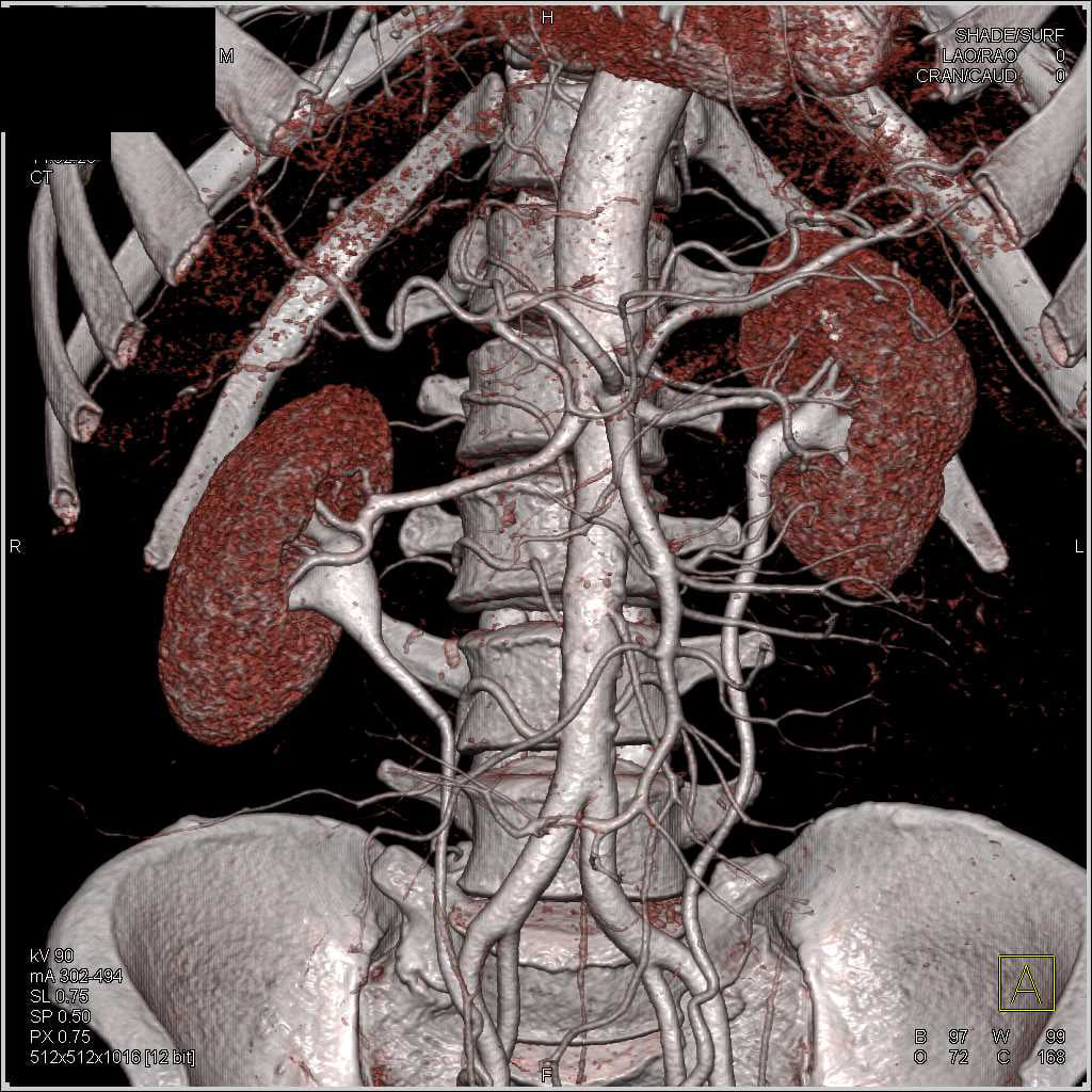 CT Urogram With Mild Medial Positioning of the Ureters:... - CTisus ...