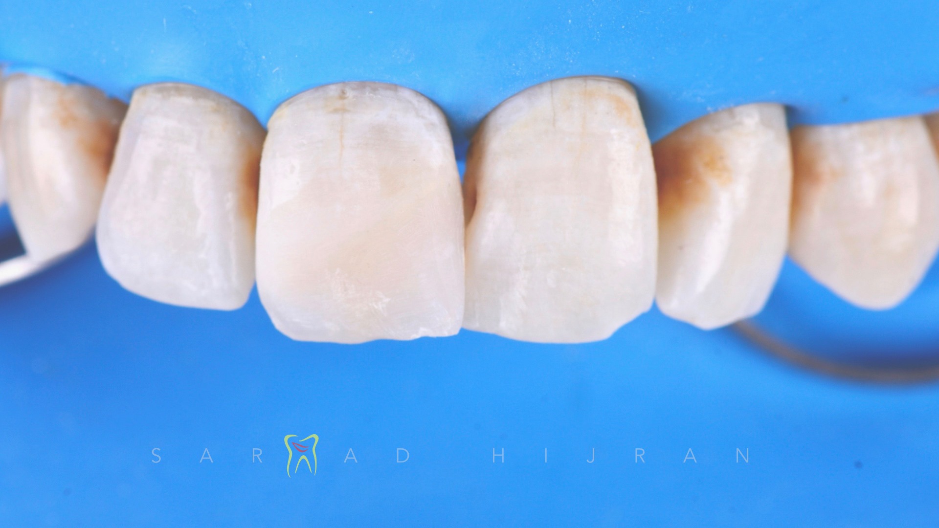 Tooth Discoloration treatment with R.C.T, Internal Bleaching & Direct ...