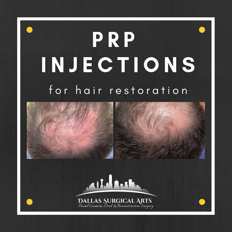 Dallas Surgical Arts - Our patients suffering from androgenic alopecia ...