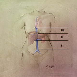 The IVC #ctisus normal.tif: Medical illustration depicting the IVC in ...