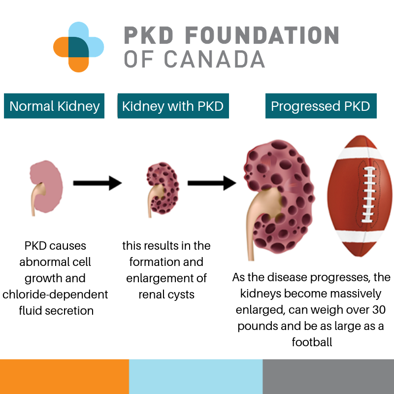 Hailey-Ann's Journey with PKD