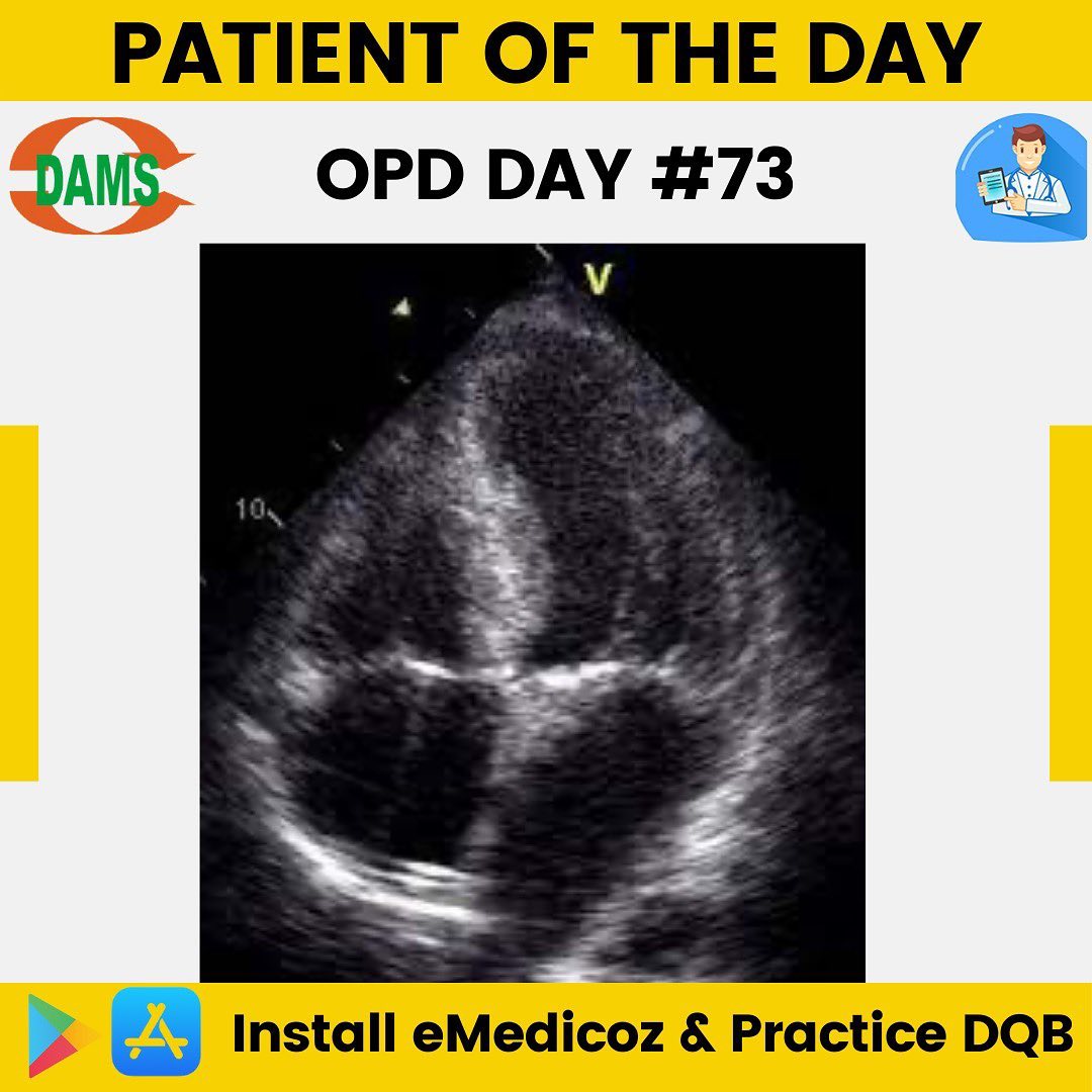 damsdelhi - In Hypertrophic Cardiomyopathy, Inappropriate hypertrophy ...