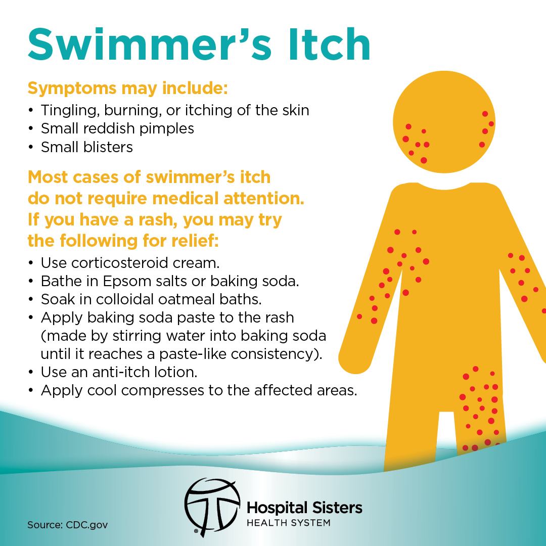 HSHS - If you’ve been swimming in the lake and now have an itchy rash ...