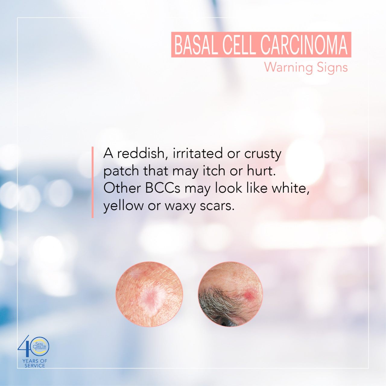 info-om-basalcellscancer-derma-to-me-hudv-rd-facebook