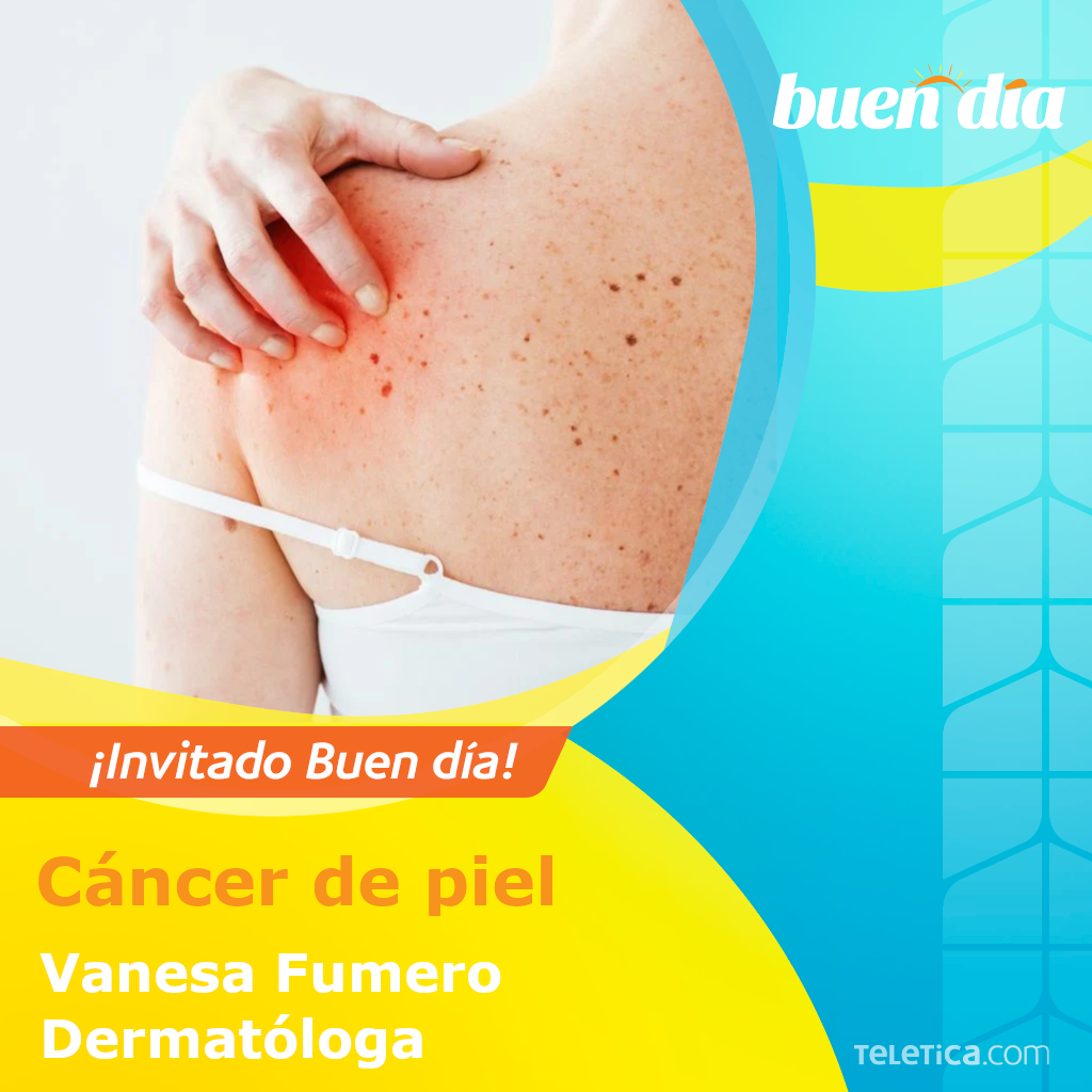 Buen Día - Conozca los síntomas del cáncer de piel, las... | Facebook