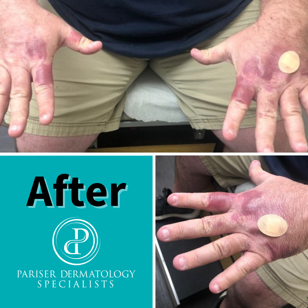 Pictured here is a case... - Pariser Dermatology Specialists | Facebook