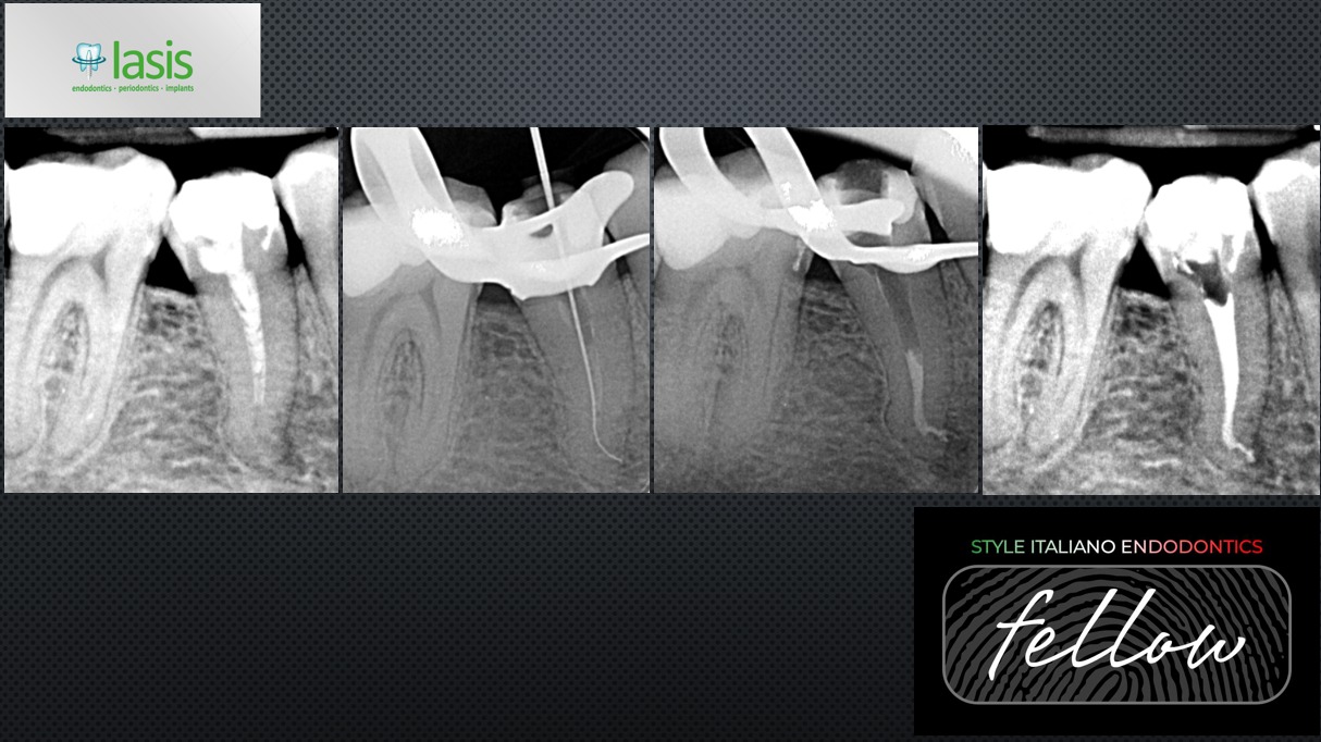 Tooth 33 has a history of ortho treatment. The tooth was grey in 