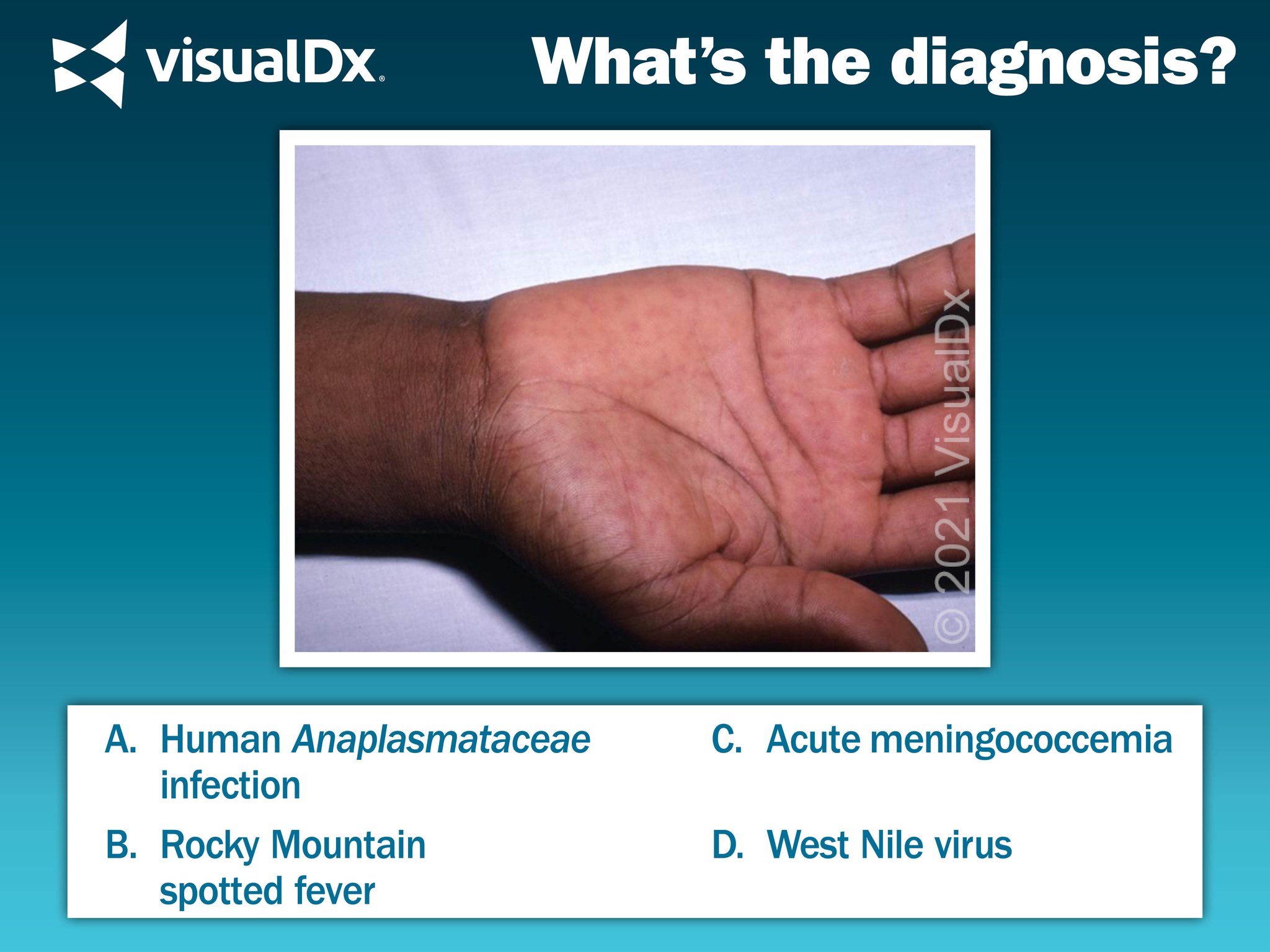 VisualDx - What's the Diagnosis? A 10-year-old girl was... | Facebook