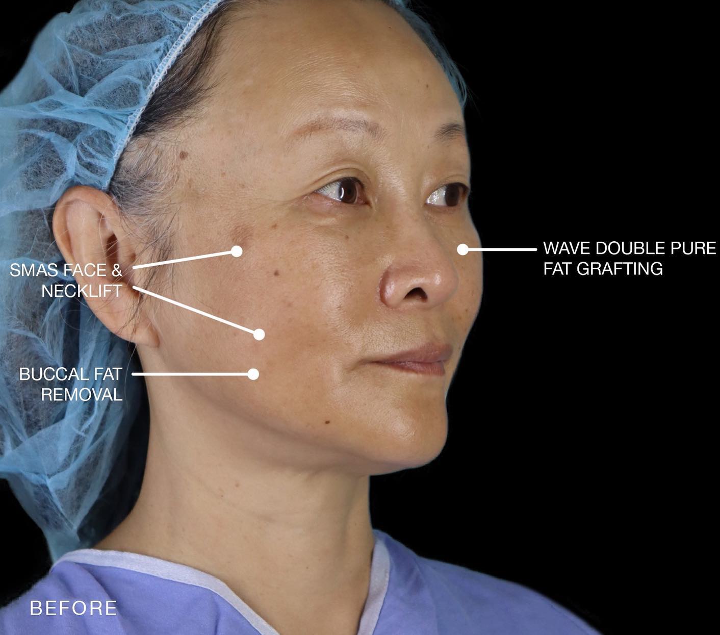 RealSelf - This 50-year-old patient received a facelift,...