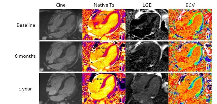 AuntMinnie.com - A new cardiac MRI technique helps...