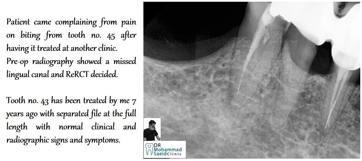 ReRCT on tooth no. 45 and 7 years follow up on tooth no. 43