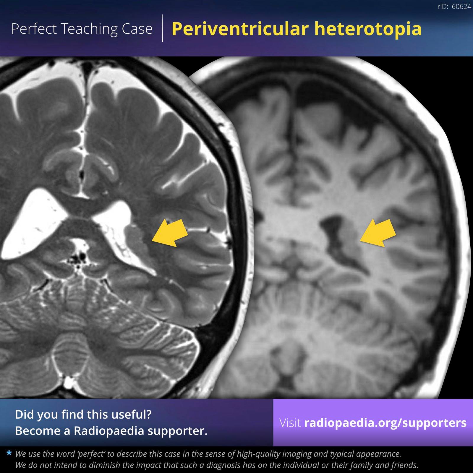 Radiopaedia.org - Perfect teaching case: Periventricular heterotopia ...