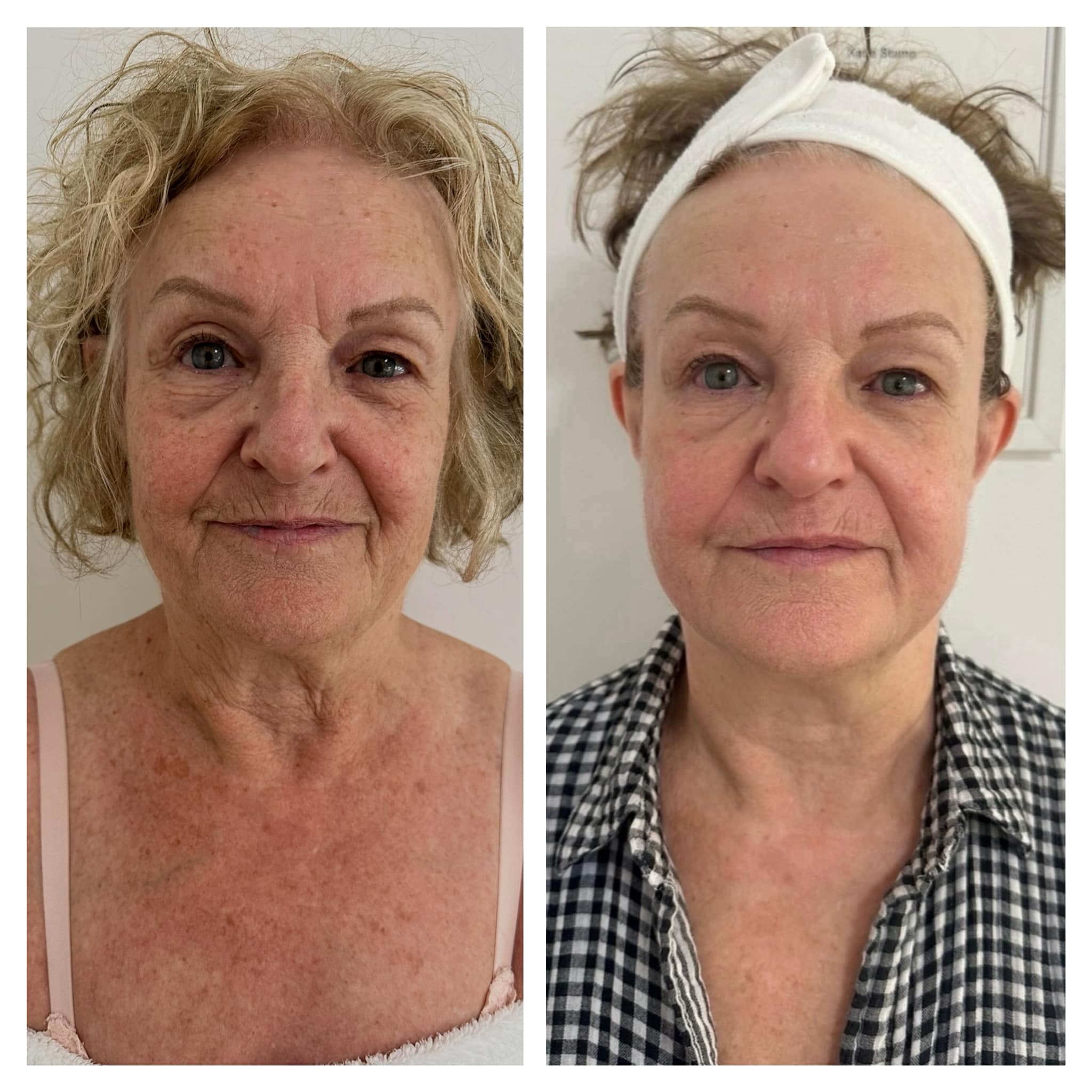 The amazing results of our Glutathione Treatment✨ The pictures speak volumes- consistent treatments show results👏 Call 0161 768 7674 to book in a free consultation with our team and start your skin