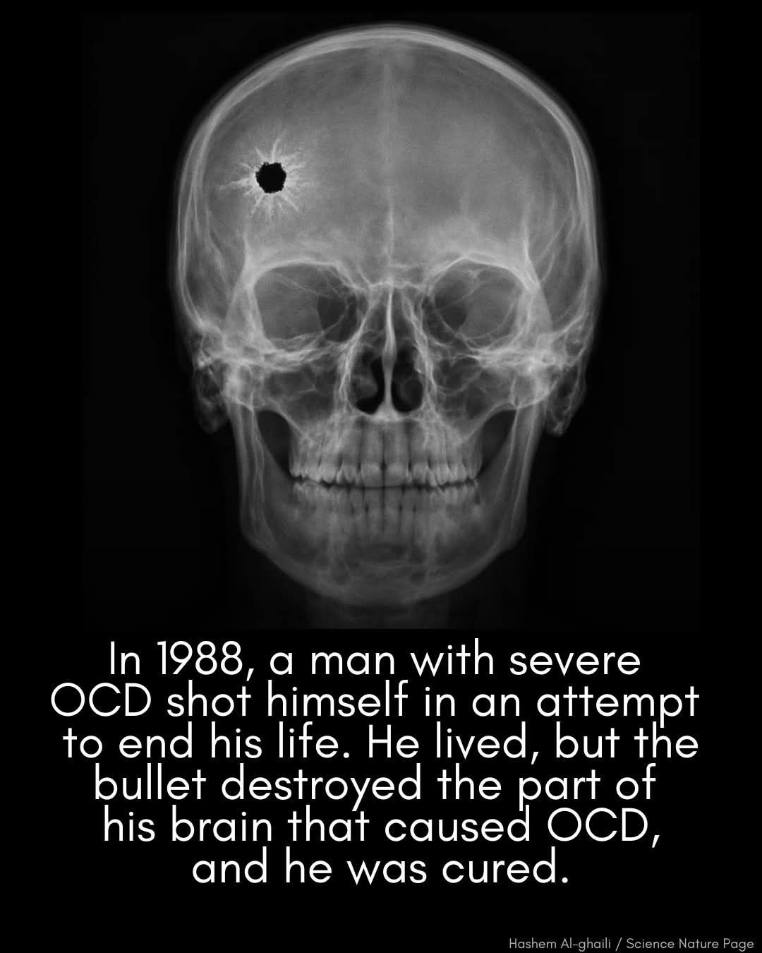 Did bullet removal improve spinal cord injury recovery?