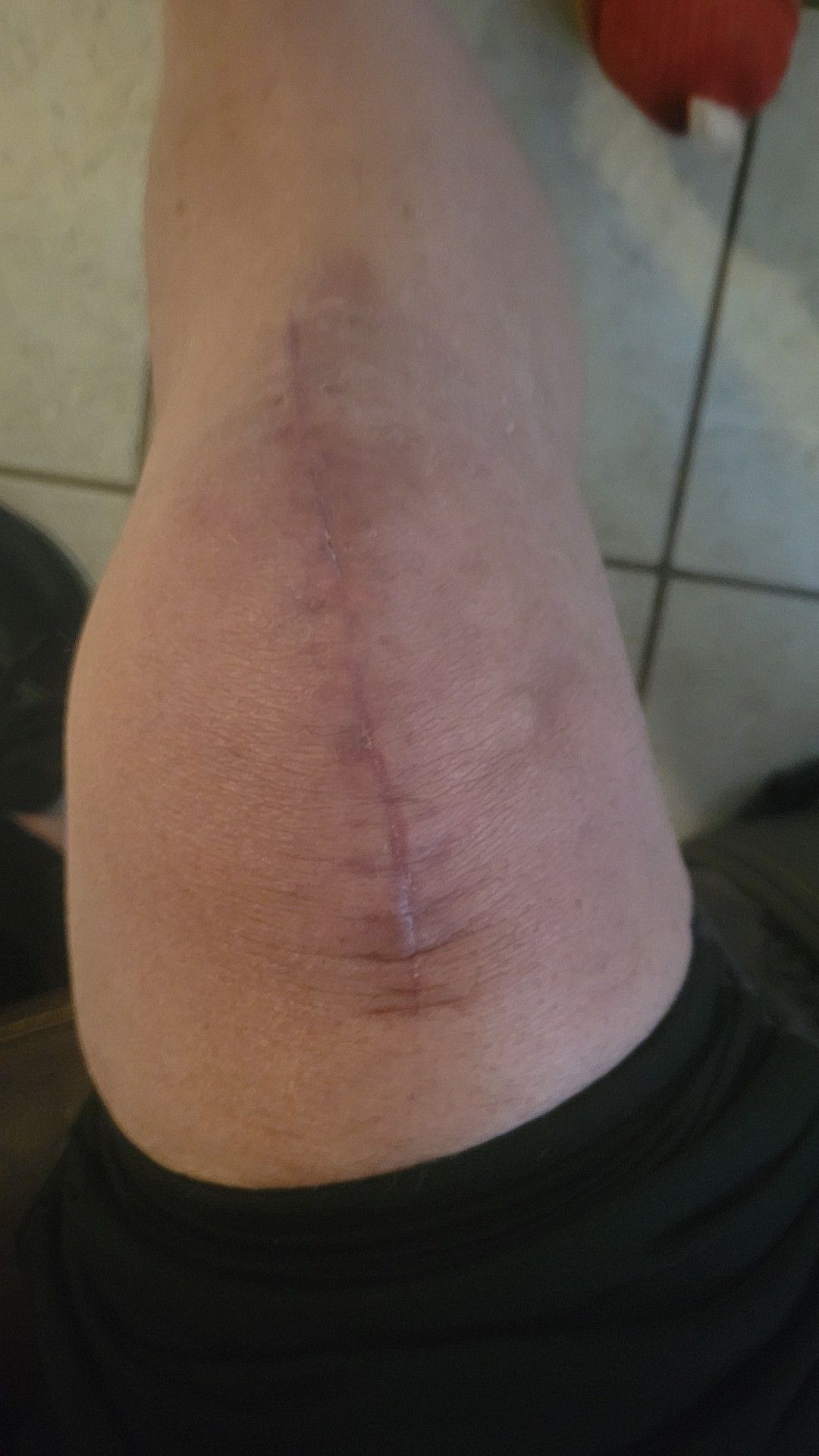 Knee feels good after replacement